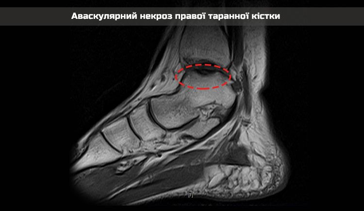X-ray-nekrosis-2