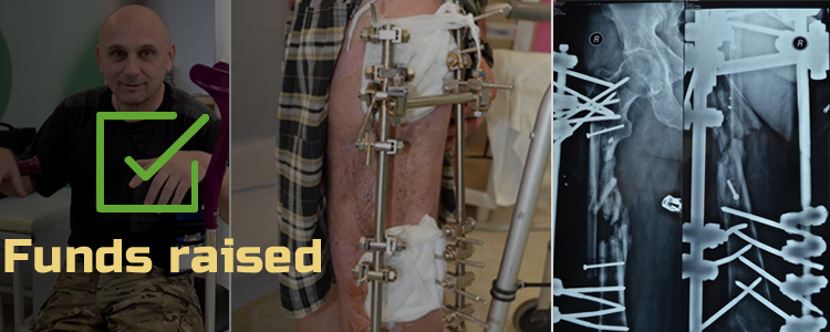 Oleh B, 47. Treatment completed, rehabilitation is in progress