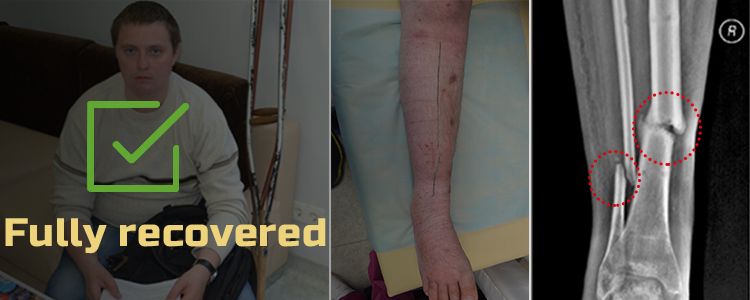 Yuriy Y, 25. Treatment successfully completed