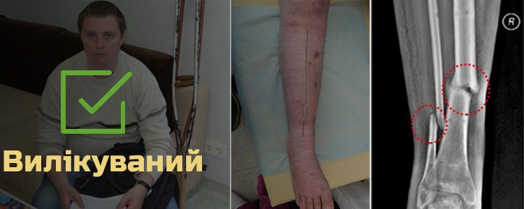 Юрій Я., 25 років. Лікування успішно завершене
