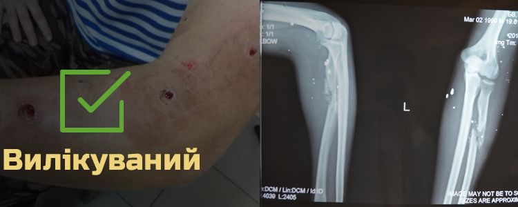 Богдан В., 25 років. Лікування успішно завершено