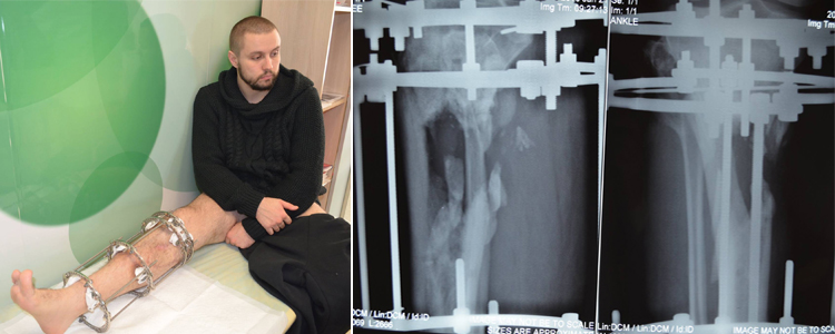 Oleksandr P, 28. Additional stage of treatment due to the trauma