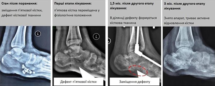 Andriy’s surgical treatment completed
