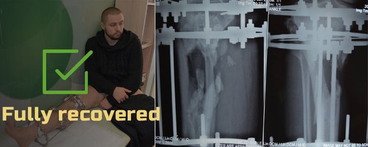 Oleksandr P, 28. Additional stage of treatment due to the trauma