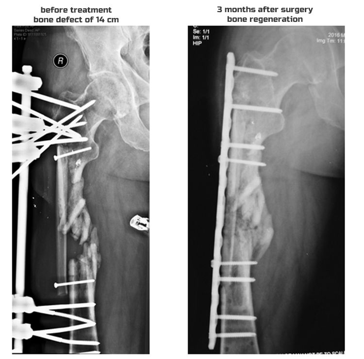 X-Ray 3 month after-english