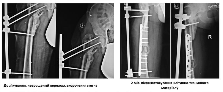 Oleg Suharev hip X-ray