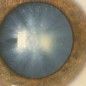 Chinese doctors grow lens of the eye using stem cells