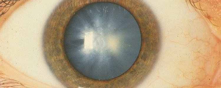 Chinese doctors grow lens of the eye using stem cells