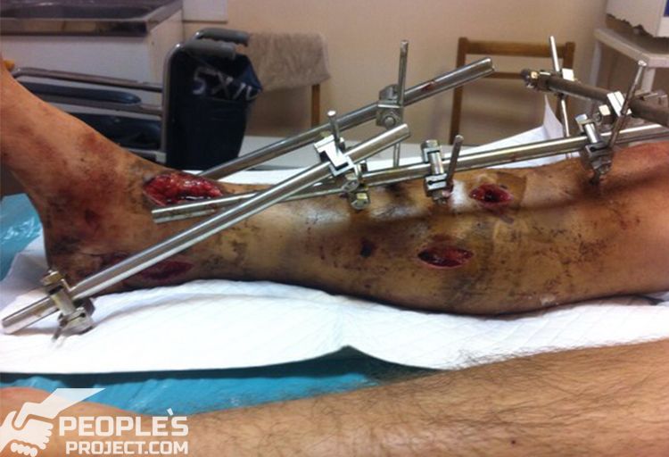 Поранена нога до початку лікування - Біотех-реабілітація поранених