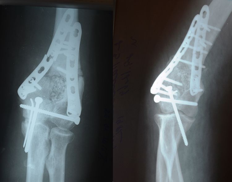 x-ray