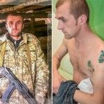 Захиснику Авдіївської промзони почали відрощувати знищений суглоб новими біотехнологіями