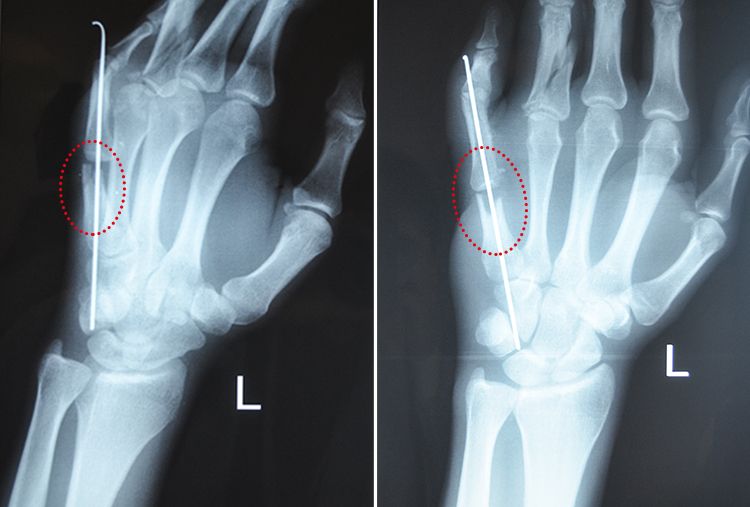 x-ray-finger