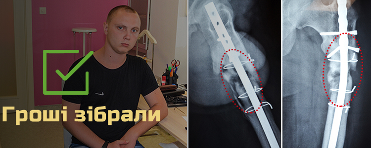 Ігор Ф., 24 роки. Лікування триває