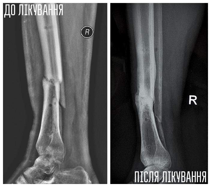 X-ray