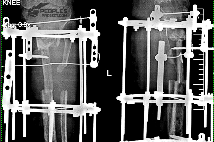 X-Ray-Volodymyr-Str