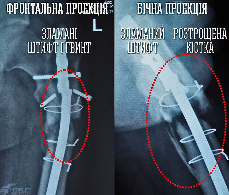 X-Ray