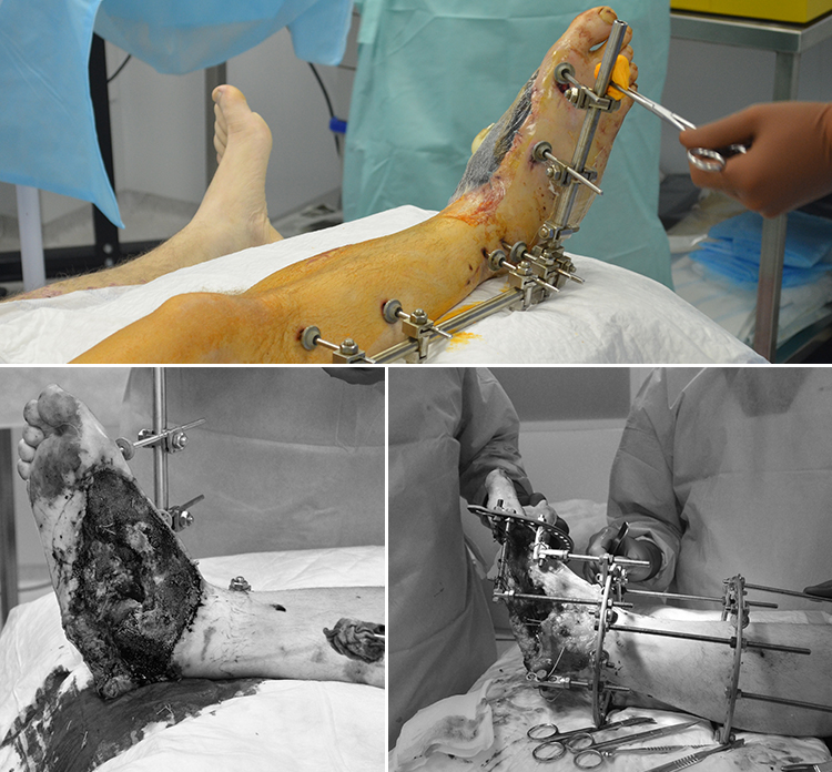 Petro Ol-in 2 surgery graphic