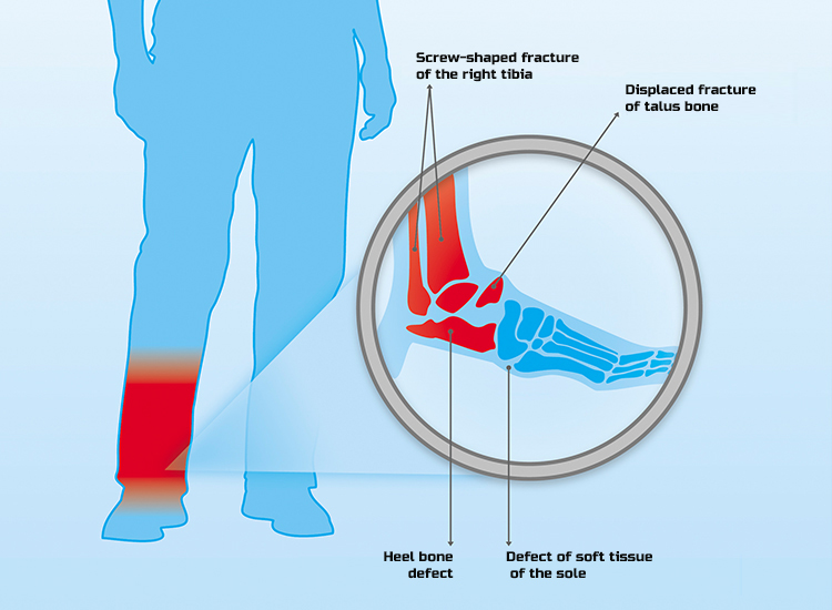 Petro Ol-injury scheme-engl