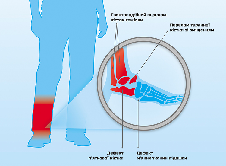 Petro Ol-injury scheme