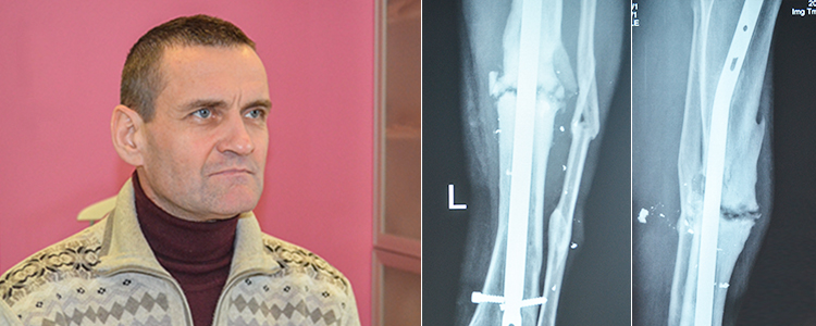 Valeriy, 52. Cost of treatment 90 294 UAH