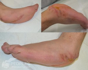 Inside-wounded-heel-2